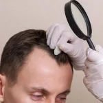 Découvrez La Solution Naturelle Contre La Perte De Cheveux Grâce à La Greffe Capillaire!